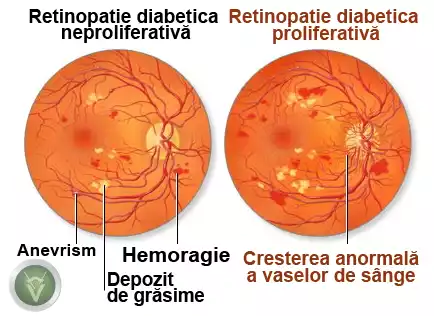 retinopatie-diabetica-2